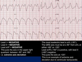 Lead I = NEGATIVE
Lead II = NEGATIVE
Lead aVF = NEGATIVE
This puts the axis in the upper right
quadrant, between -90° and 180°,
i.e. extreme axis deviation
The most isoelectric lead is aVL (-30°).
The QRS axis must be at ± 90° from aVL at
either +60° or -120°.
Lead aVR (-150°) is positive, with lead II
(+60°) negative.
This puts the axis at -120°.
This is an example of extreme axis
deviation due to ventricular tachycardia.
 