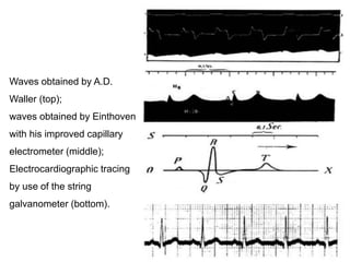 Waves obtained by A.D.
Waller (top);
waves obtained by Einthoven
with his improved capillary
electrometer (middle);
Electrocardiographic tracing
by use of the string
galvanometer (bottom).
 