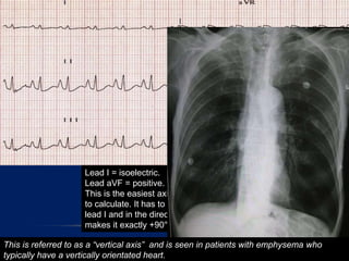 Lead I = isoelectric.
Lead aVF = positive.
This is the easiest axis you will ever have
to calculate. It has to be at right angles to
lead I and in the direction of aVF, which
makes it exactly +90°!
This is referred to as a “vertical axis” and is seen in patients with emphysema who
typically have a vertically orientated heart.
 