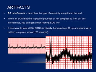 ARTIFACTS
• AC interference – describes the type of electricity we get from the wall.
• When an ECG machine is poorly grounded or not equipped to filter out this
interference, you can get a thick looking ECG line.
• If one were to look at this ECG line closely, he would see 60 up-and-down wave
pattern in a given second (25 squares).
 