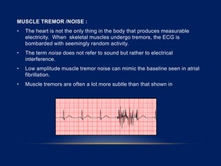 MUSCLE TREMOR /NOISE :
• The heart is not the only thing in the body that produces measurable
electricity. When skeletal muscles undergo tremors, the ECG is
bombarded with seemingly random activity.
• The term noise does not refer to sound but rather to electrical
interference.
• Low amplitude muscle tremor noise can mimic the baseline seen in atrial
fibrillation.
• Muscle tremors are often a lot more subtle than that shown in
 