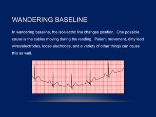 WANDERING BASELINE
In wandering baseline, the isoelectric line changes position. One possible
cause is the cables moving during the reading. Patient movement, dirty lead
wires/electrodes, loose electrodes, and a variety of other things can cause
this as well.
 