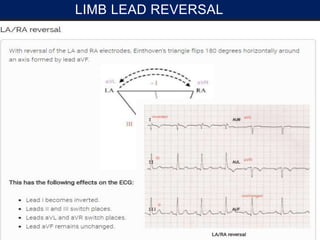 LIMB LEAD REVERSAL
 