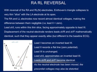 RA RL REVERSAL
With reversal of the RA and RL(N) electrodes, Einthoven’s triangle collapses to
very thin “slice” with the LA electrode at its apex.
The RA and LL electrodes now record almost identical voltages, making the
difference between them negligible (i.e, lead II = zero).
Lead aVL runs within this thin slice, facing approximately opposite to lead III.
Displacement of the neutral electrode renders leads aVR and aVF mathematically
identical, such that they appear exactly alike (but different to the baseline ECG).
Lead I becomes an inverted lead III.
Lead II records a flat line (zero potential).
Lead III is unchanged.
Lead aVL approximates an inverted lead III.
Leads aVR and aVF become identical.
As the neutral electrode has been moved, the
precordial voltages may also be distorted.
 