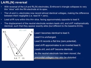 LA/RL(N) reversal
• With reversal of the LA and RL(N) electrodes, Einthoven’s triangle collapses to very
thin “slice” with the RA electrode at its apex.
• The LA and LL electrodes now record almost identical voltages, making the difference
between them negligible (i.e. lead III = zero).
• Lead aVR runs within this thin slice, facing approximately opposite to lead II.
• The displacement of the neutral electrode renders leads aVL and aVF mathematically
identical, such that they appear exactly alike (but different to the baseline ECG).
Lead I becomes identical to lead II.
Lead II is unchanged.
Lead III records a flat line (zero potential).
Lead aVR approximates to an inverted lead II.
Leads aVL and aVF become identical.
As the neutral electrode has been moved, the
precordial voltages may also be distorted.
 
