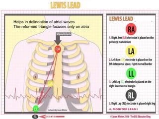 Helps in delineation of atrial waves
The reformed triangle focuses only on atria
 