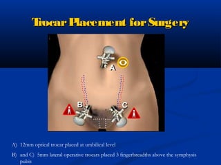 Basics in gyne laparoscopy | PPT