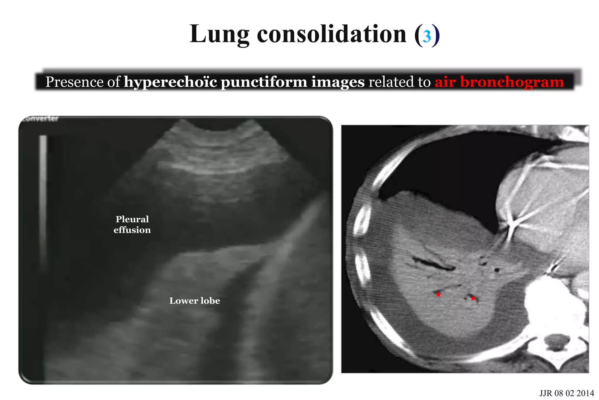 Basic skills in transthoracic lung ultrasound | PPT