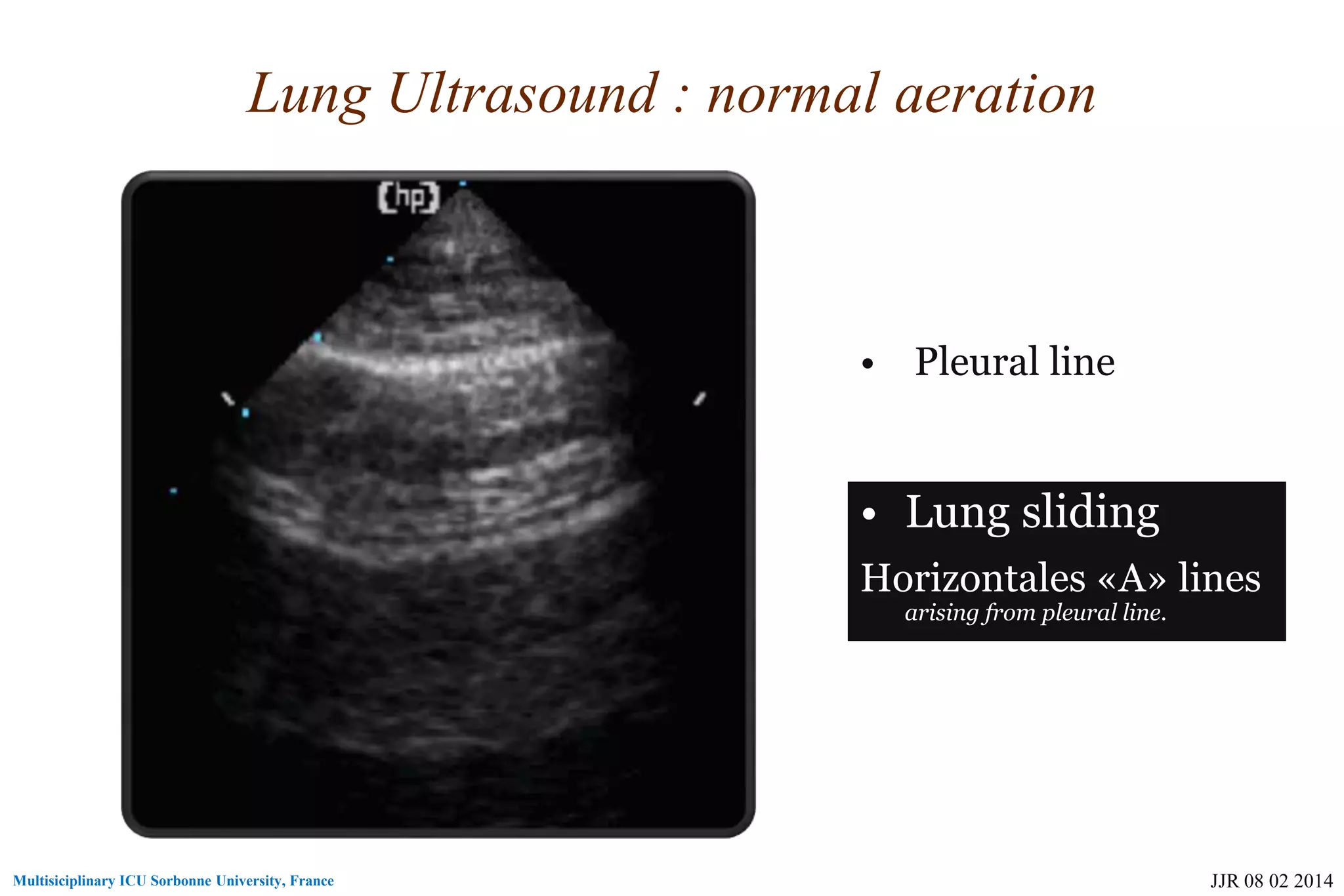 Basic skills in transthoracic lung ultrasound | PPT