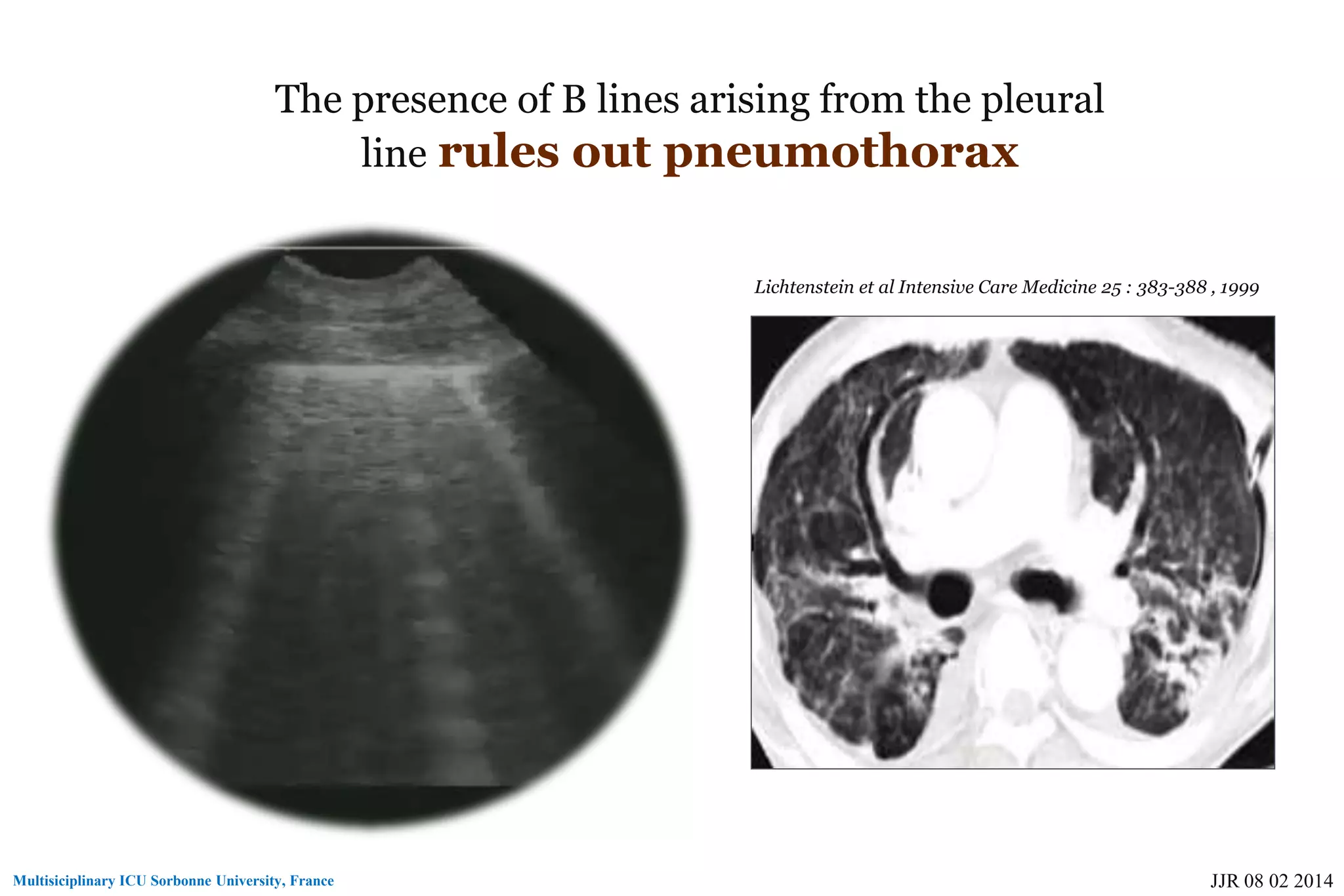 Basic skills in transthoracic lung ultrasound | PPT