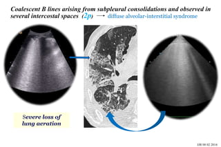 Basic skills in transthoracic lung ultrasound | PPTX