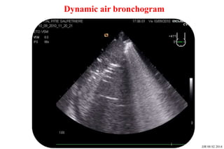 Basic skills in transthoracic lung ultrasound | PPTX