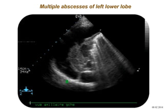 Basic skills in transthoracic lung ultrasound | PPTX