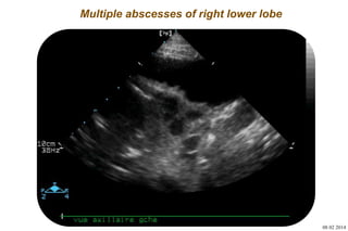 Basic skills in transthoracic lung ultrasound | PPTX