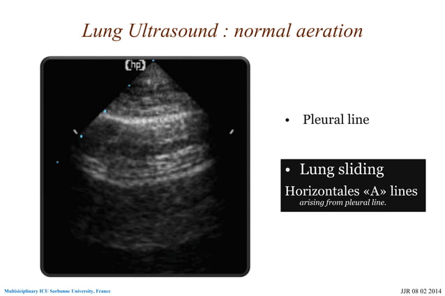 Basic skills in transthoracic lung ultrasound | PPT