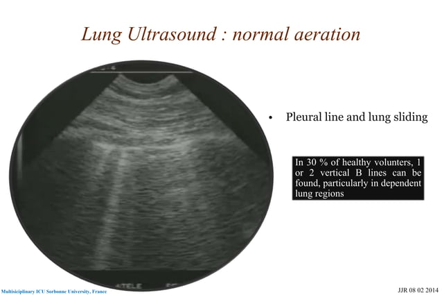 Basic skills in transthoracic lung ultrasound | PPT