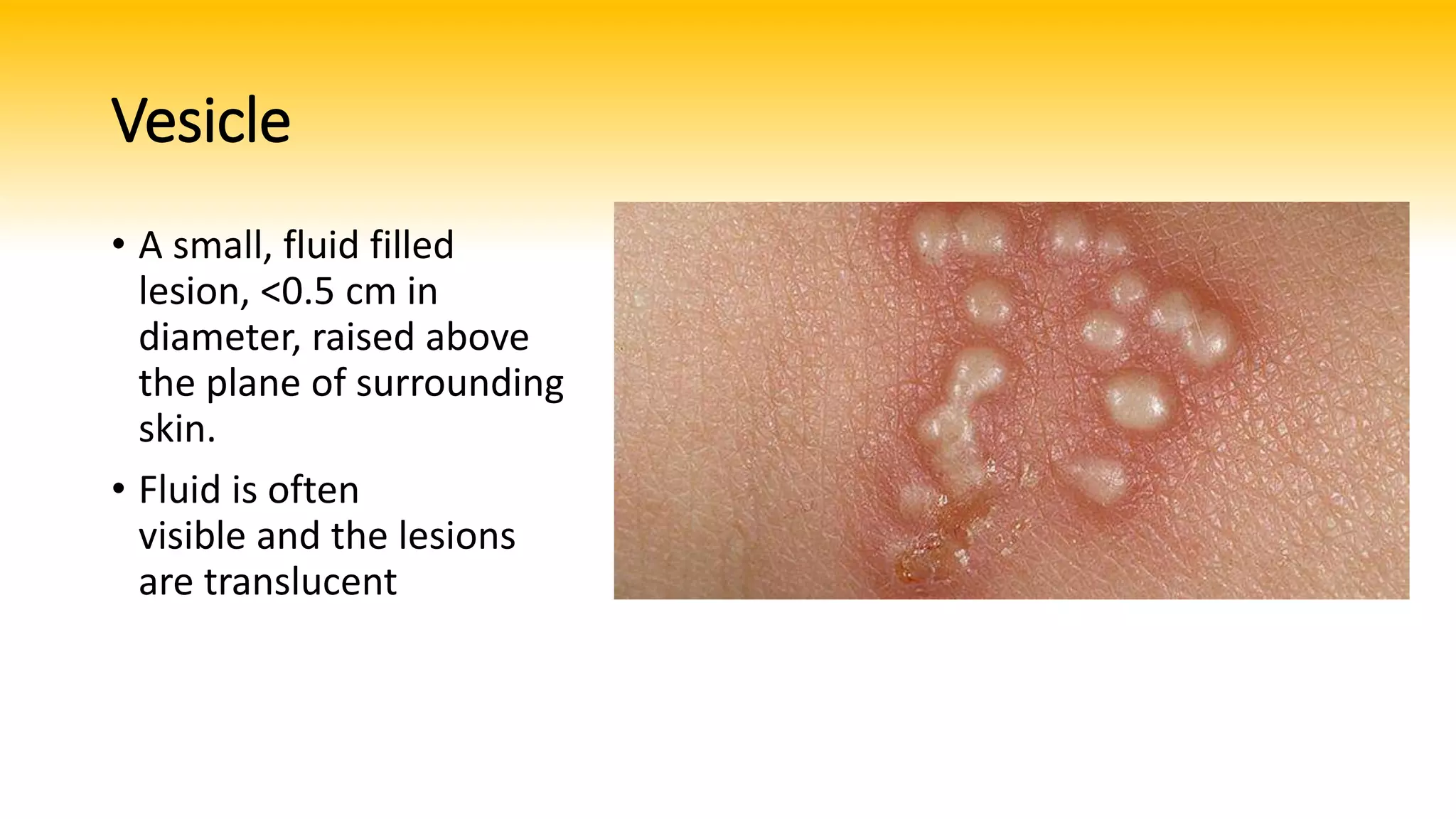 Basic skin lesions | PPTX