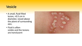 Vesication Basic skin lesions | PPTX