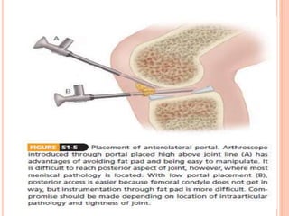 Basics of arthroscopy ppt | PPTX