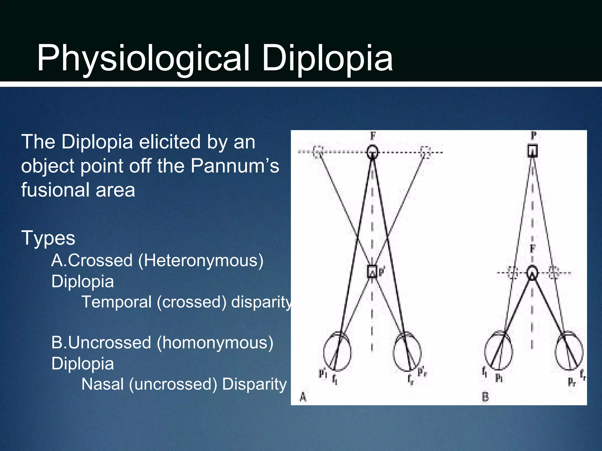 Physiological Diplopia
The Diplopia elicited by an
object point off the Pannum’s
fusional area
Types
A.Crossed (Heteronymous)
Diplopia
Temporal (crossed) disparity
B.Uncrossed (homonymous)
Diplopia
Nasal (uncrossed) Disparity
 