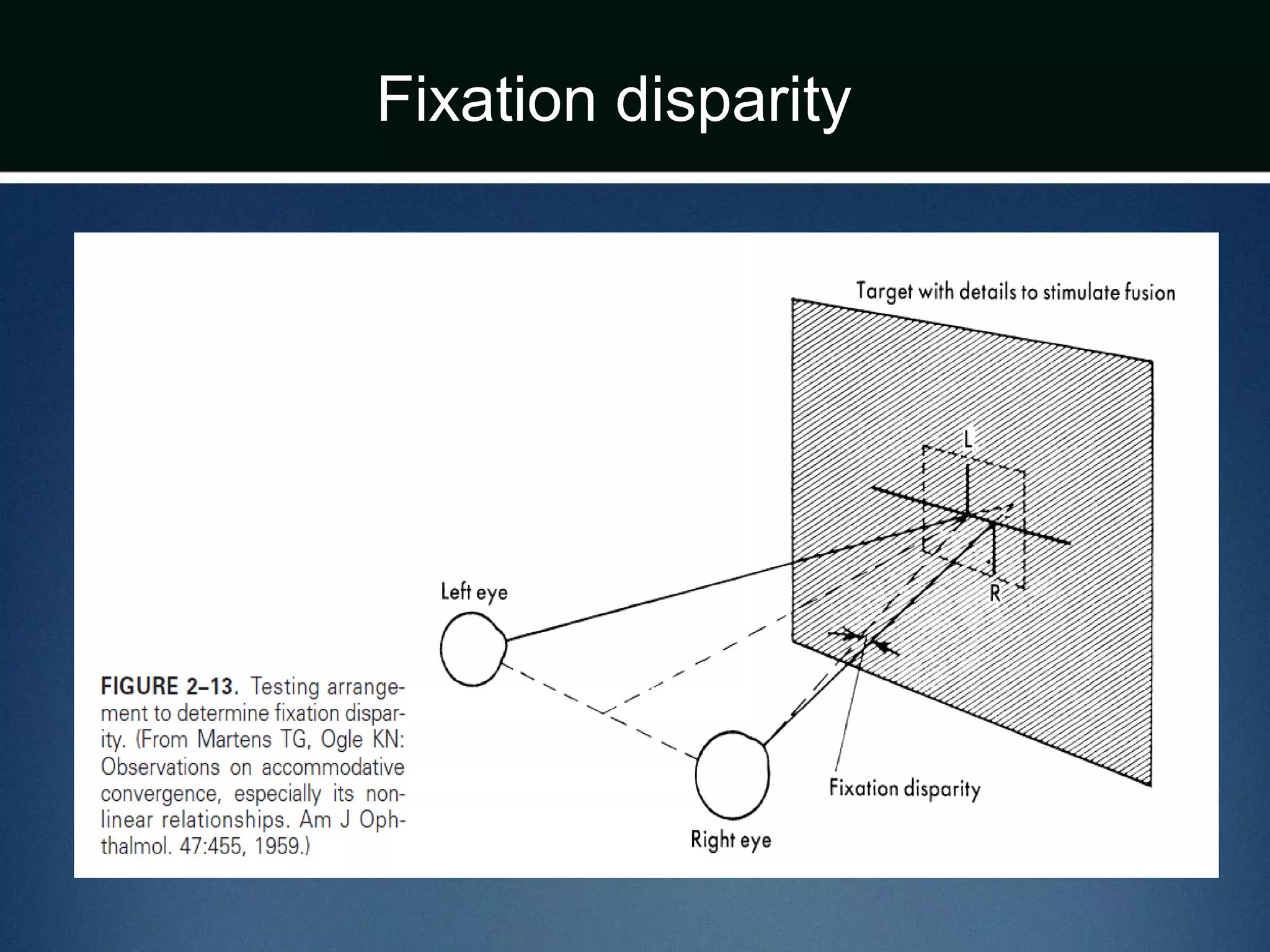Fixation disparity
 