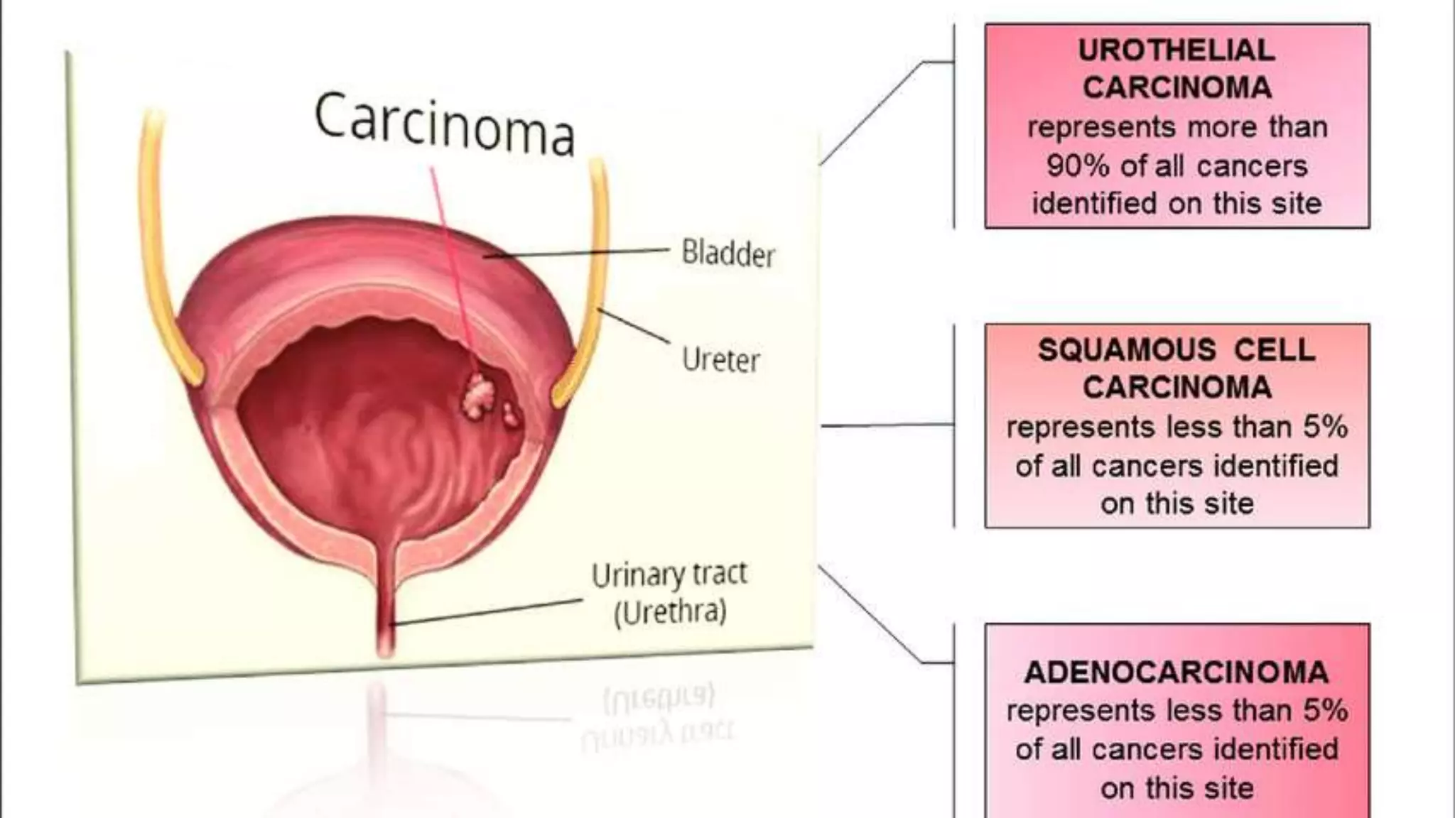 Basics of bladder tumors | PPTX