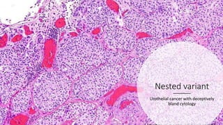 Basics of bladder tumors | PPTX