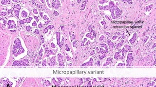 Basics of bladder tumors | PPTX