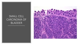 Basics of bladder tumors | PPTX