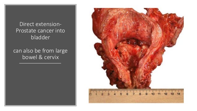 Basics of bladder tumors
