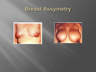 Breast Assymetry
