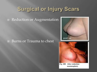 Surgical or Injury ScarsReduction or AugmentationBurns or Trauma to chest