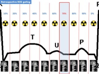10% 20% 0%90%80%70%60%50%40%30%
Retrospective ECG gating
 