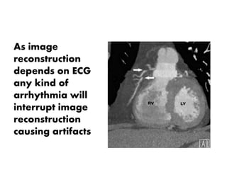 As image
reconstruction
depends on ECG
any kind of
arrhythmia will
interrupt image
reconstruction
causing artifacts
 