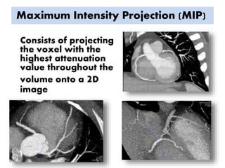 Maximum Intensity Projection (MIP)
Consists of projecting
the voxel with the
highest attenuation
value throughout the
volume onto a 2D
image
 