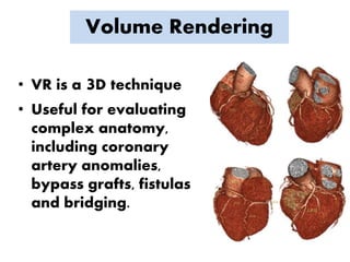 Volume Rendering
• VR is a 3D technique
• Useful for evaluating
complex anatomy,
including coronary
artery anomalies,
bypass grafts, fistulas
and bridging.
 