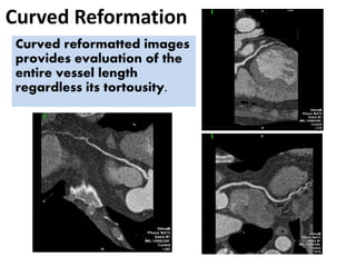 Curved Reformation
Curved reformatted images
provides evaluation of the
entire vessel length
regardless its tortousity.
 