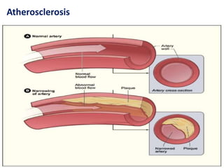Atherosclerosis
 