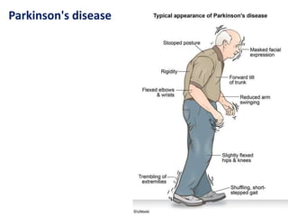 Parkinson's disease
 