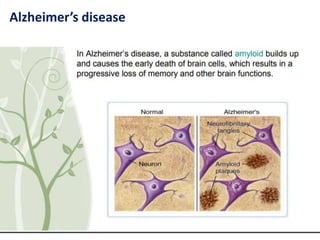 Alzheimer’s disease
 