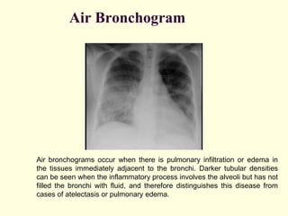 Basics of Chest X-ray Interpretation.pptx
