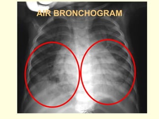Basics of Chest X-ray Interpretation.pptx