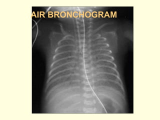 Basics of Chest X-ray Interpretation.pptx