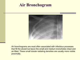 Basics of Chest X-ray Interpretation.pptx