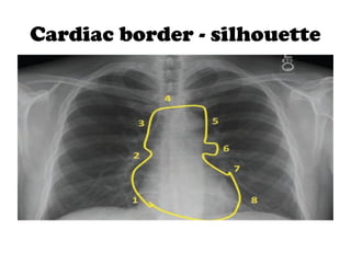 basics_of_chest_xray.pptx basic of chest x ray | PPTX