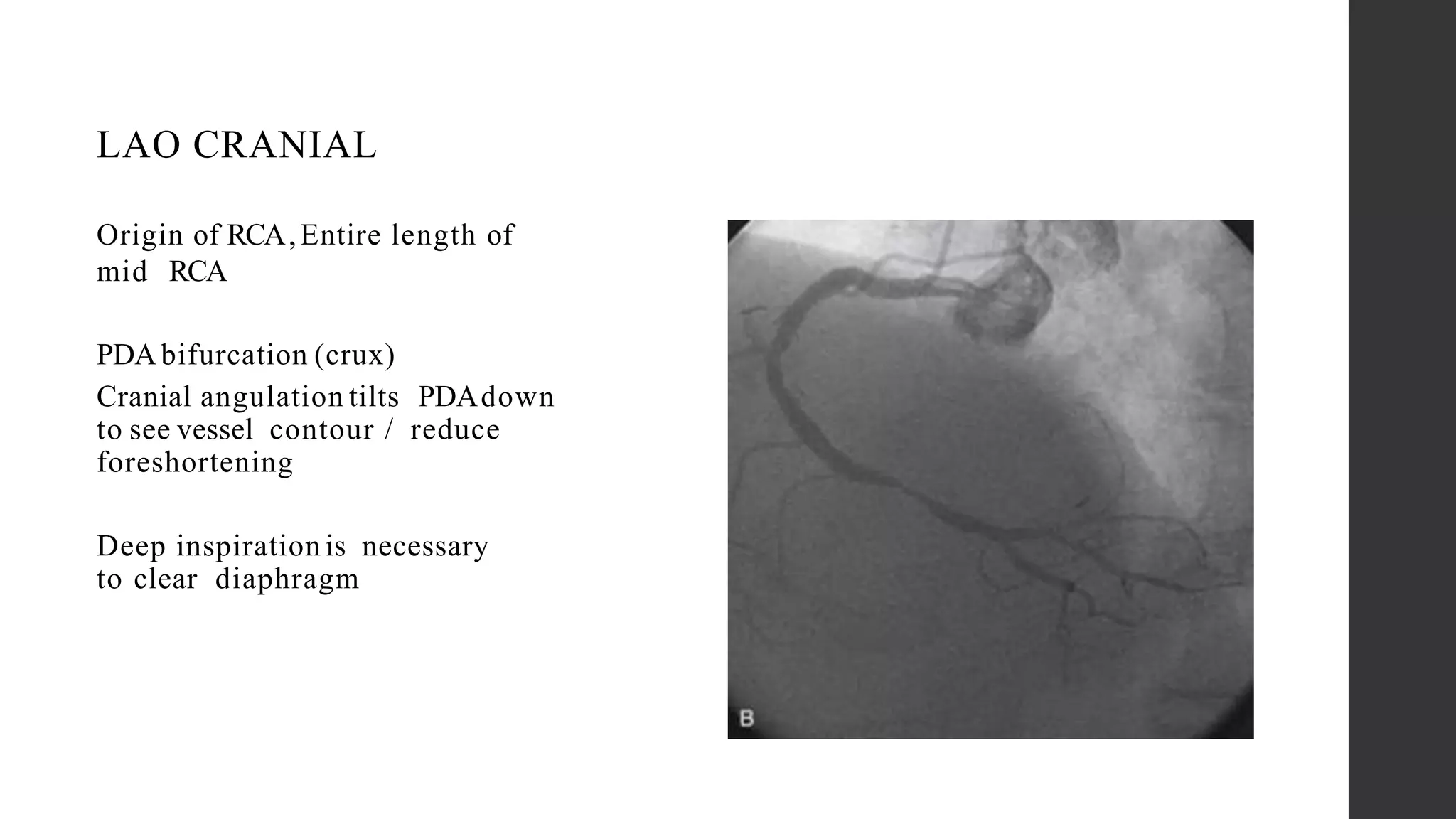 Basics of coronary artery anatomy and angiographic views | PPTX