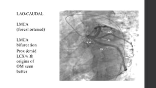 Lmca Block Basics of coronary artery anatomy and angiographic views | PPTX