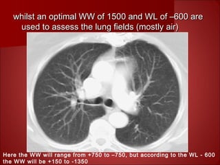 whilst an optimal WW of 1500 and WL of –600 arewhilst an optimal WW of 1500 and WL of –600 are
used to assess the lung fields (mostly air)used to assess the lung fields (mostly air)
Here the WW will range from +750 to –750, but according to the WL - 600
the WW will be +150 to -1350
 