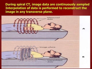 During spiral CT, image data are continuously sampled
Interpolation of data is performed to reconstruct the
image in any transverse plane.
 