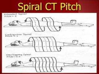 Spiral CT Pitch
 